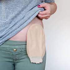 Ostomy/Stoma Care and Accessories Market Size, Future Trends, Growth Key Factors, Demand, Application, Scope, and Opportunities Analysis by Outlook 2029